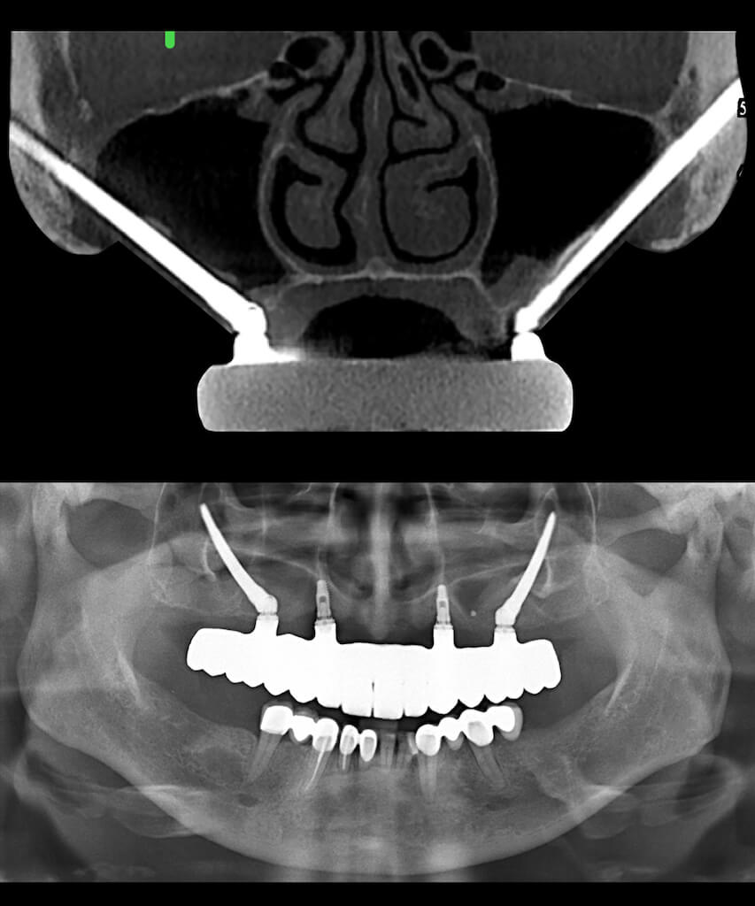 zygomatic implants